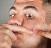 acne_to_conceal